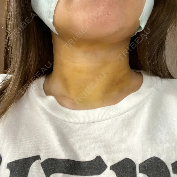 糸リフト / 脂肪吸引（顔） / ジョールファット除去 / その他（輪郭） 湘南美容クリニック 秋葉原院 DAY 3 メイン用