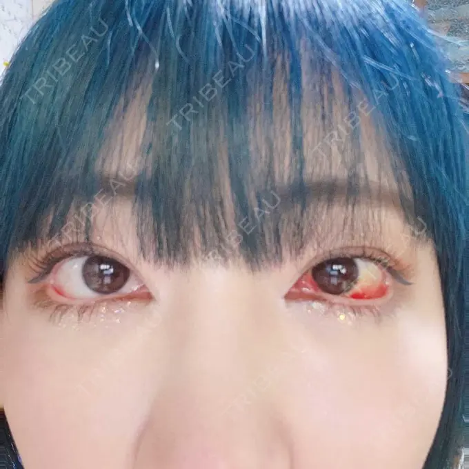 下まぶたたるみ取り / 下まぶたの脂肪取り 湘南美容クリニック 藤沢院 DAY 9 メイン用