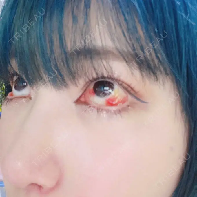 下まぶたたるみ取り / 下まぶたの脂肪取り 湘南美容クリニック 藤沢院 DAY 7 メイン用