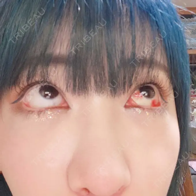 下まぶたたるみ取り / 下まぶたの脂肪取り 湘南美容クリニック 藤沢院 DAY 5 メイン用