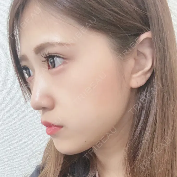 脂肪溶解注射（顔） 新宿美容外科クリニック 新宿院 AFTER メイン用