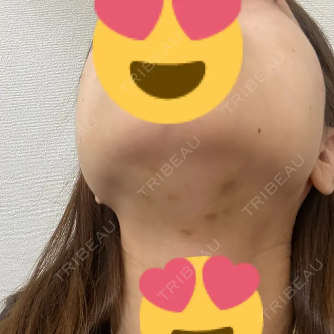 脂肪溶解注射（顔） 新宿美容外科クリニック 新宿院 DAY 4 メイン用