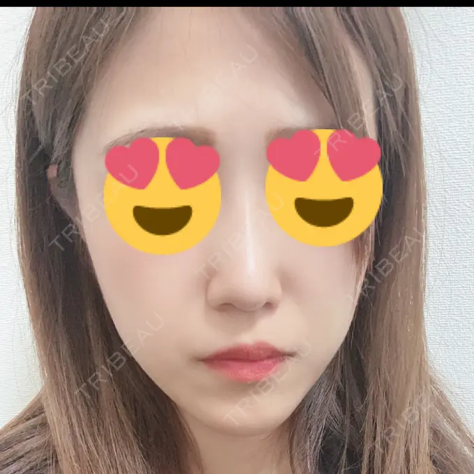 脂肪溶解注射（顔） 新宿美容外科クリニック 新宿院 DAY 4 メイン用