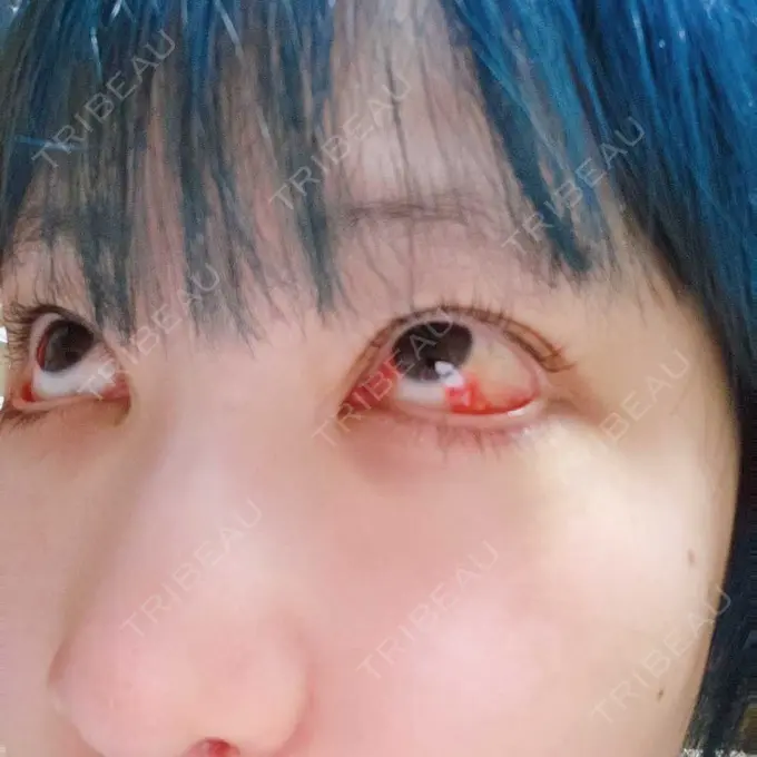 下まぶたたるみ取り / 下まぶたの脂肪取り 湘南美容クリニック 藤沢院 AFTER メイン用