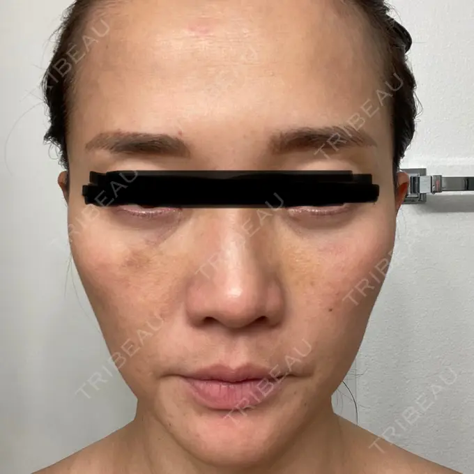 クマ治療 / シワ取りボトックス セオリークリニック DAY 4 メイン用