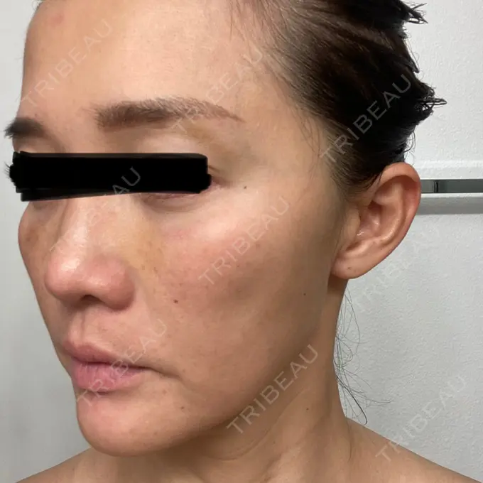 クマ治療 / シワ取りボトックス セオリークリニック DAY 4 メイン用