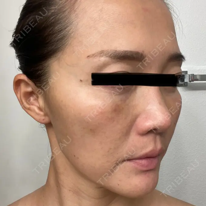 クマ治療 / シワ取りボトックス セオリークリニック DAY 4 メイン用