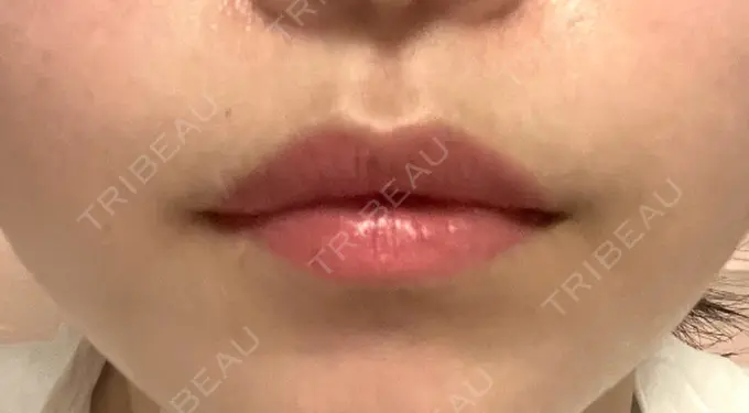アートメイク（唇） 筋肉・美容クリニック AFTER メイン用