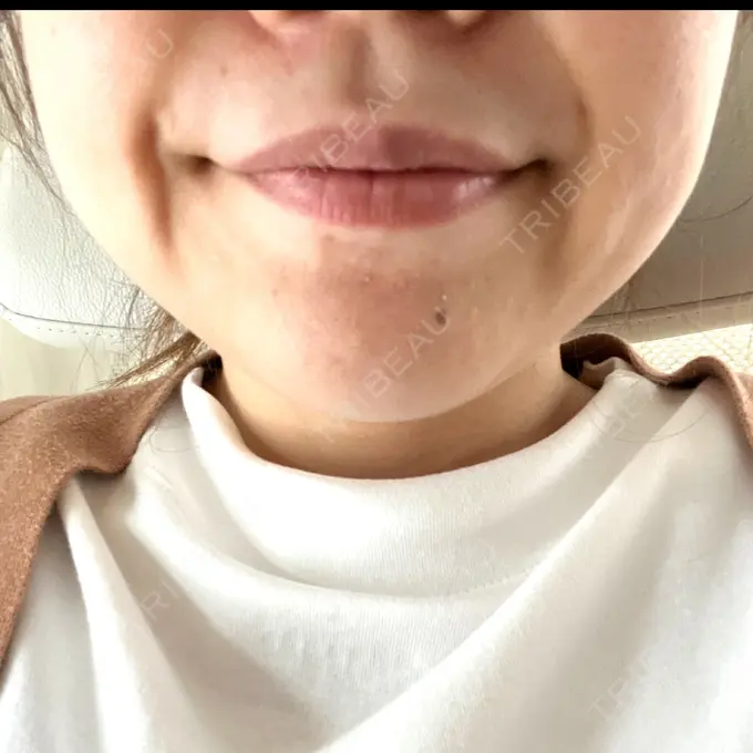 ボトックス（エラ・小顔） / 脂肪溶解注射（顔） / ピーリング（ハリ・ツヤ） アリエル美容クリニック 大宮院 DAY 10 メイン用