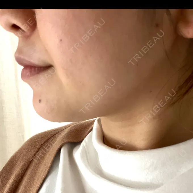 ボトックス（エラ・小顔） / 脂肪溶解注射（顔） / ピーリング（ハリ・ツヤ） アリエル美容クリニック 大宮院 DAY 10 メイン用