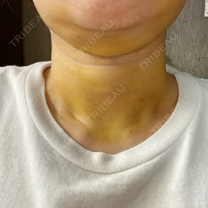 糸リフト / 脂肪吸引（顔） / ジョールファット除去 / その他（輪郭） 湘南美容クリニック 秋葉原院 DAY 7 メイン用