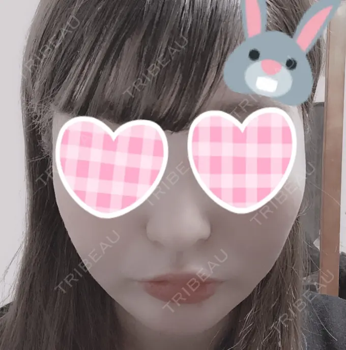 バッカルファット除去 / 脂肪吸引（顔） / ボトックス（あご） / ヒアルロン酸注入（あご） / ボトックス（エラ・小顔） / ヒアルロン酸注入（唇） / ボトックス（口角） エートップ美容整形外科 DAY 41 メイン用