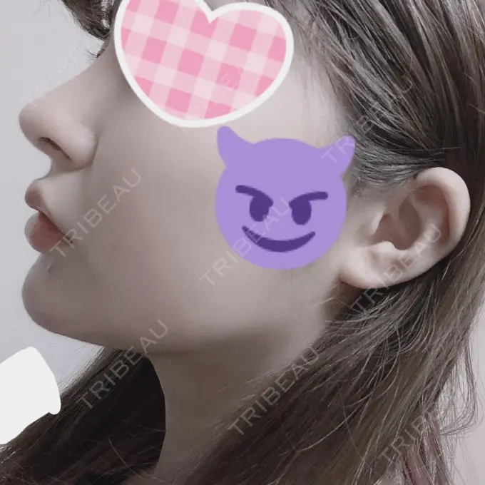 バッカルファット除去 / 脂肪吸引（顔） / ボトックス（あご） / ヒアルロン酸注入（あご） / ボトックス（エラ・小顔） / ヒアルロン酸注入（唇） / ボトックス（口角） エートップ美容整形外科 DAY 41 メイン用