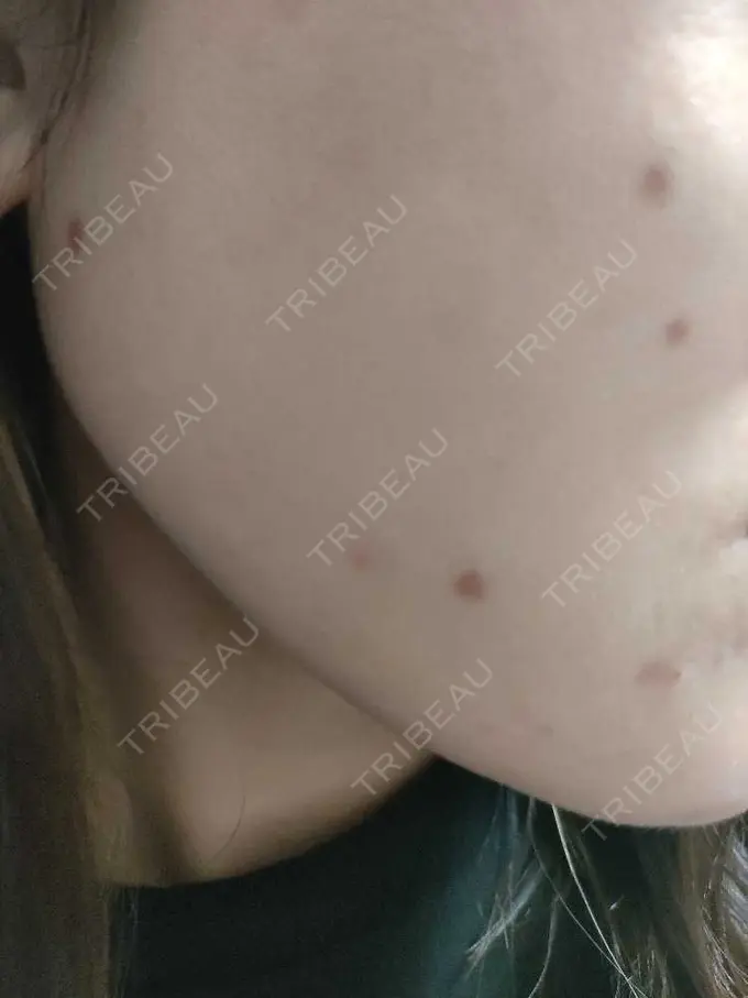 シミ取りレーザー 小田原マタニティクリニック AFTER メイン用