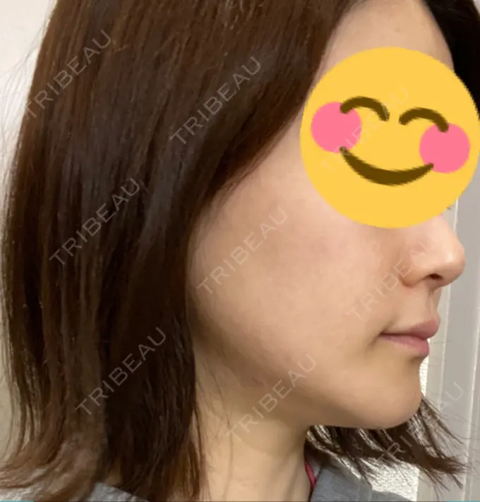 骨切り（あご） / 骨削り（エラ） / セットバック / その他（輪郭） アーククリニック DAY 37 メイン用