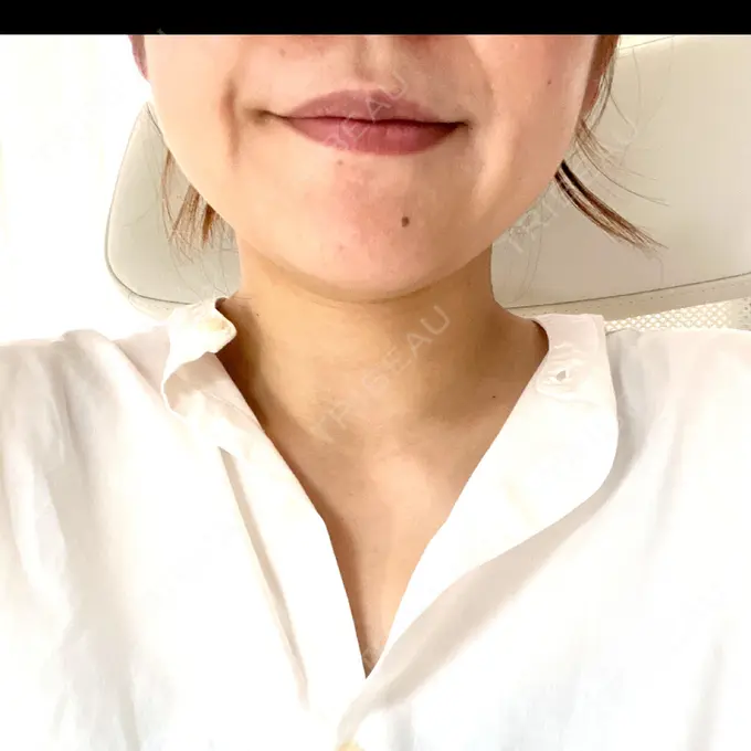 ボトックス（エラ・小顔） / 脂肪溶解注射（顔） / ピーリング（ハリ・ツヤ） アリエル美容クリニック 大宮院 DAY 11 メイン用