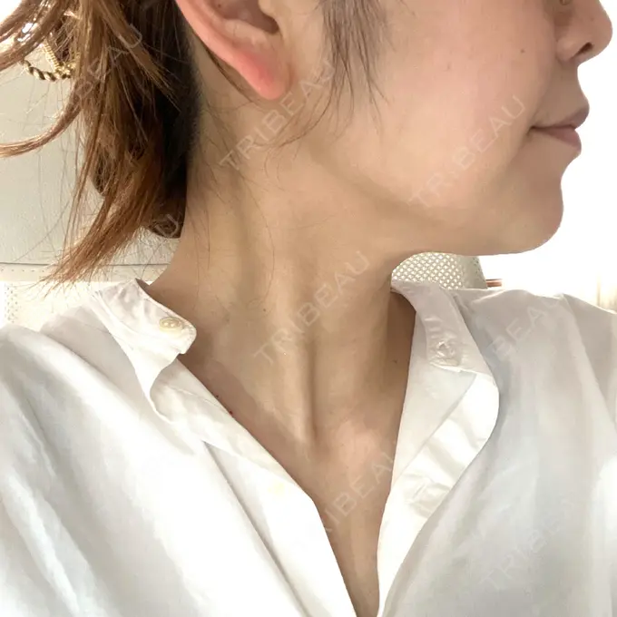 ボトックス（エラ・小顔） / 脂肪溶解注射（顔） / ピーリング（ハリ・ツヤ） アリエル美容クリニック 大宮院 DAY 11 メイン用