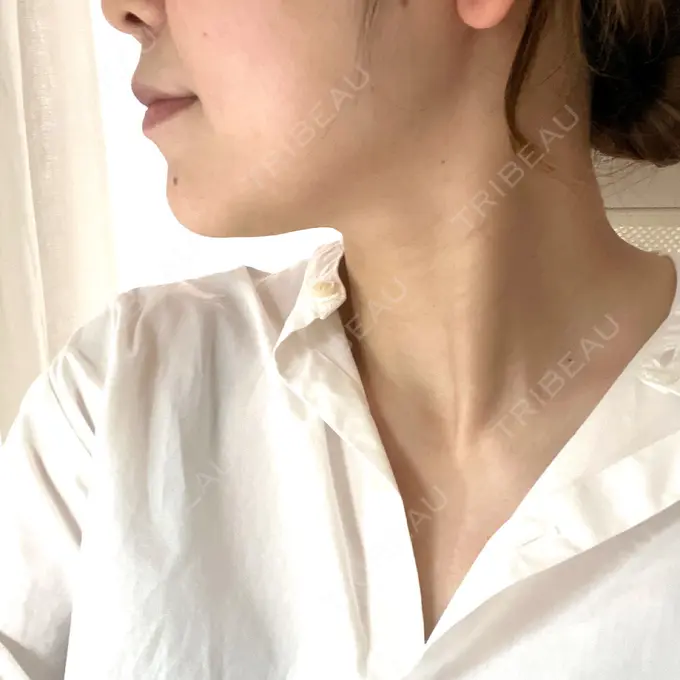 ボトックス（エラ・小顔） / 脂肪溶解注射（顔） / ピーリング（ハリ・ツヤ） アリエル美容クリニック 大宮院 DAY 11 メイン用