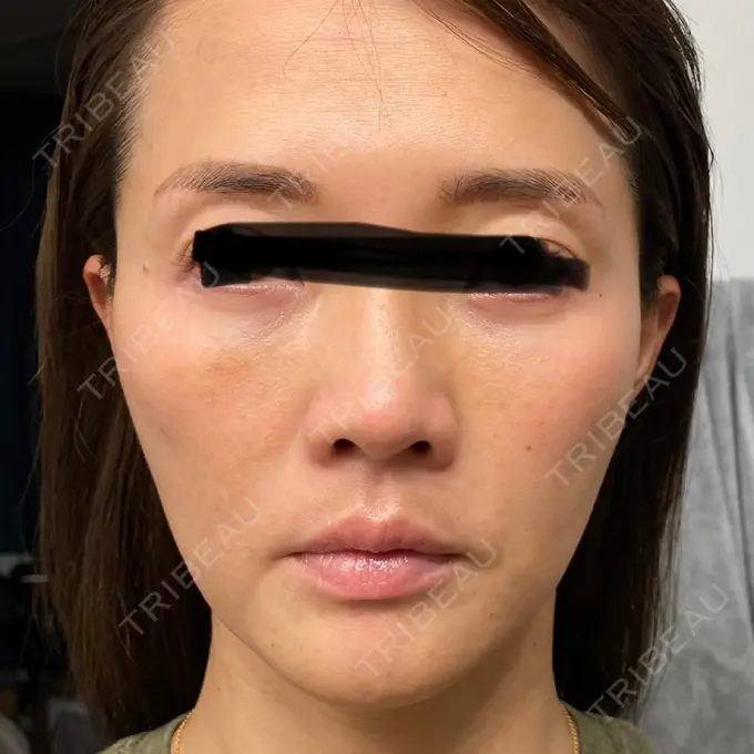 クマ治療 / シワ取りボトックス セオリークリニック DAY 7 メイン用