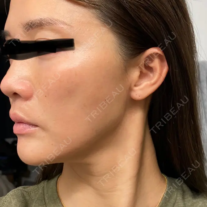 クマ治療 / シワ取りボトックス セオリークリニック DAY 7 メイン用