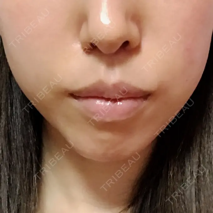 あごプロテーゼ / 骨切り（あご） ジョウクリニック 大阪院 AFTER メイン用