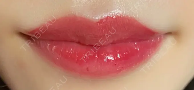 ボトックス（口角） LEAGRANT CLINIC 中目黒 AFTER メイン用