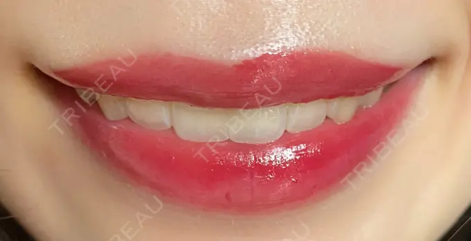 ボトックス（口角） LEAGRANT CLINIC 中目黒 DAY 10 メイン用