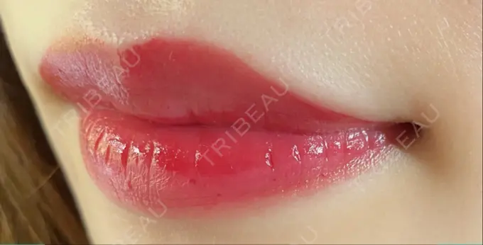 ボトックス（口角） LEAGRANT CLINIC 中目黒 DAY 10 メイン用