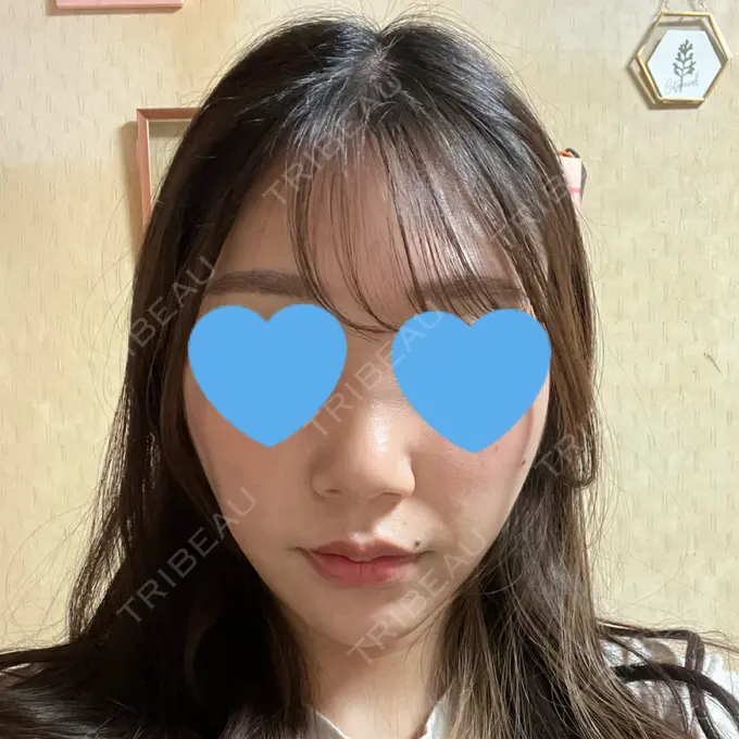 糸リフト / 脂肪吸引（顔） 湘南美容クリニック 長野院 DAY 140 メイン用