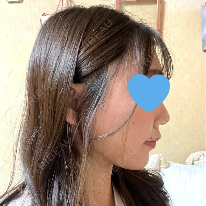 糸リフト / 脂肪吸引（顔） 湘南美容クリニック 長野院 DAY 140 メイン用