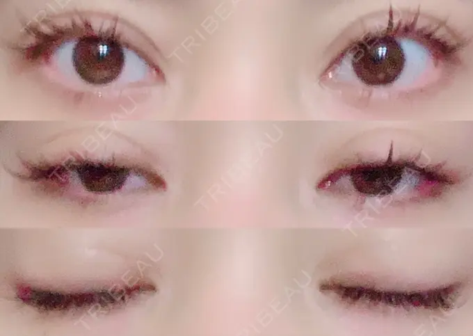 二重切開 / 目頭切開 湘南美容クリニック 池袋西口院 DAY 171 メイン用