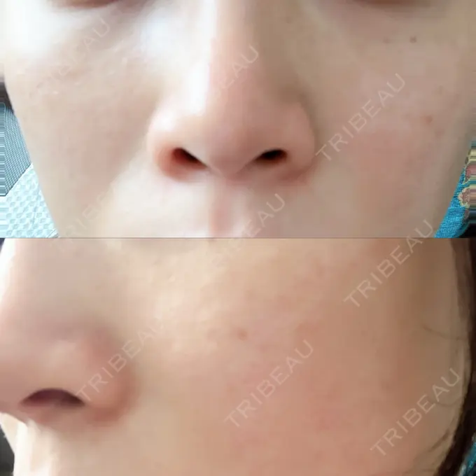 光治療（フォトフェイシャルなど） メディアージュクリニック 青山院 AFTER メイン用