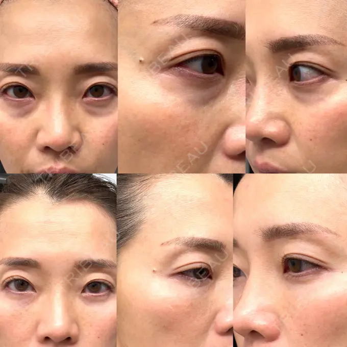 クマ治療 / シワ取りボトックス セオリークリニック AFTER メイン用