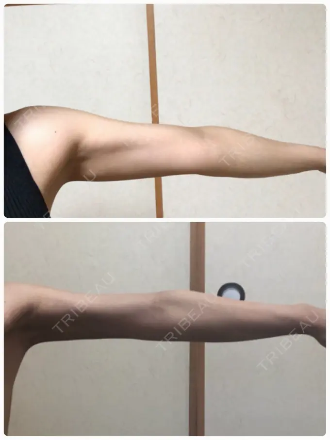 脂肪吸引（二の腕） ヨンセスリムライン DAY 45 メイン用
