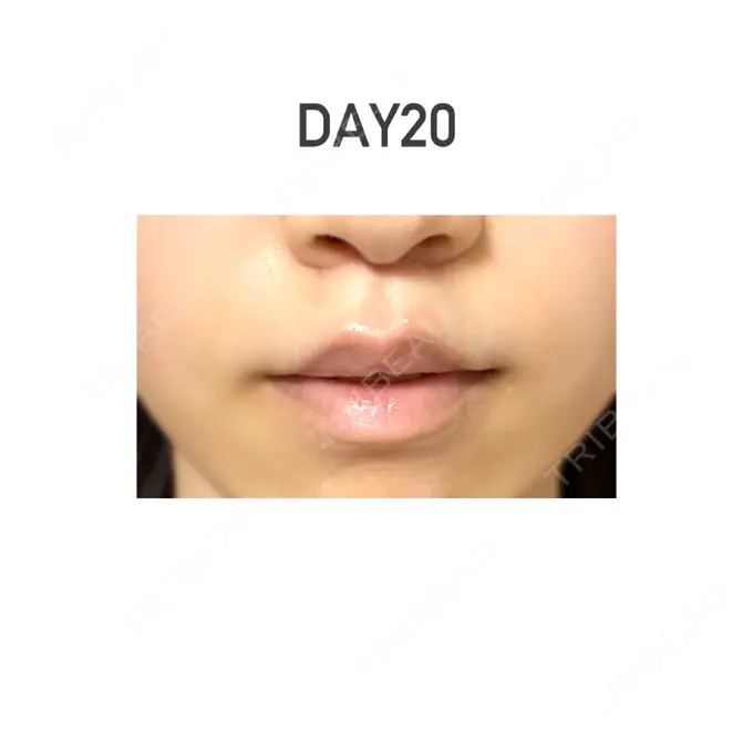 人中短縮 新宿ラクル美容外科クリニック 新宿院 DAY 20 メイン用