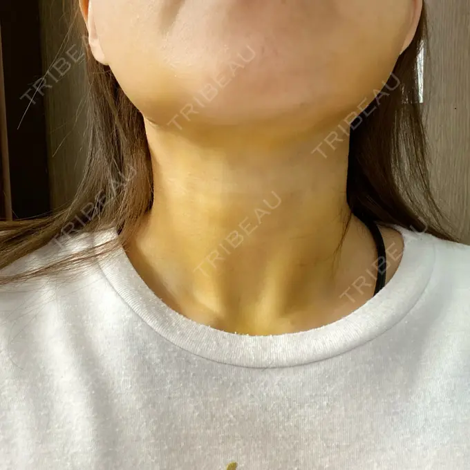 糸リフト / 脂肪吸引（顔） / ジョールファット除去 / その他（輪郭） 湘南美容クリニック 秋葉原院 DAY 13 メイン用