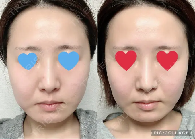 ハイフ（顔） / LED治療 Beauty Clinic the GINZA DAY 3 メイン用