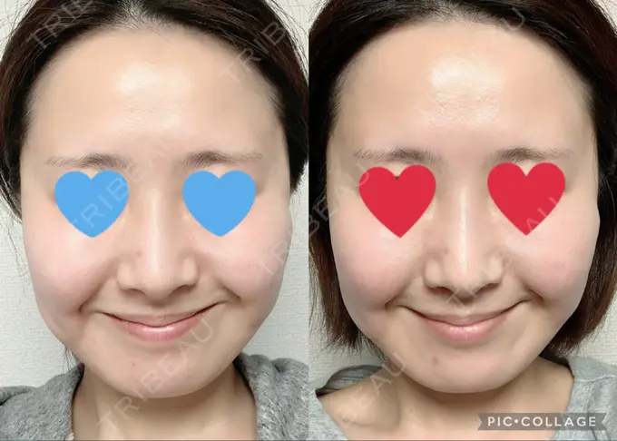 ハイフ（顔） / LED治療 Beauty Clinic the GINZA DAY 3 メイン用