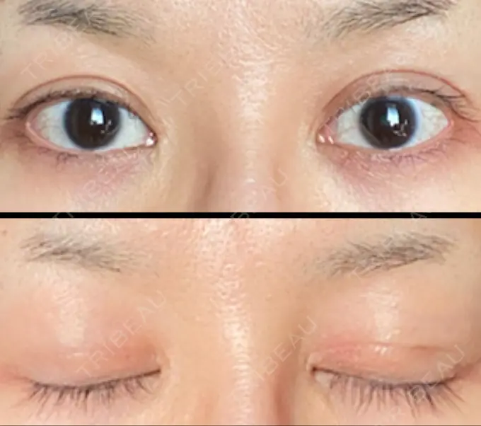 二重切開 / 目頭切開 湘南美容クリニック 六本木院 DAY 91 メイン用