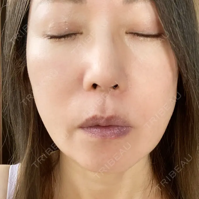 糸リフト / 脂肪吸引（顔） / ジョールファット除去 / その他（輪郭） 湘南美容クリニック 秋葉原院 DAY 17 メイン用