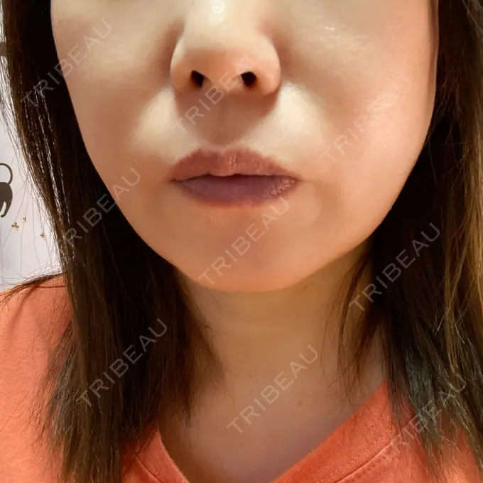 糸リフト / 脂肪吸引（顔） / ジョールファット除去 / その他（輪郭） 湘南美容クリニック 秋葉原院 DAY 21 メイン用