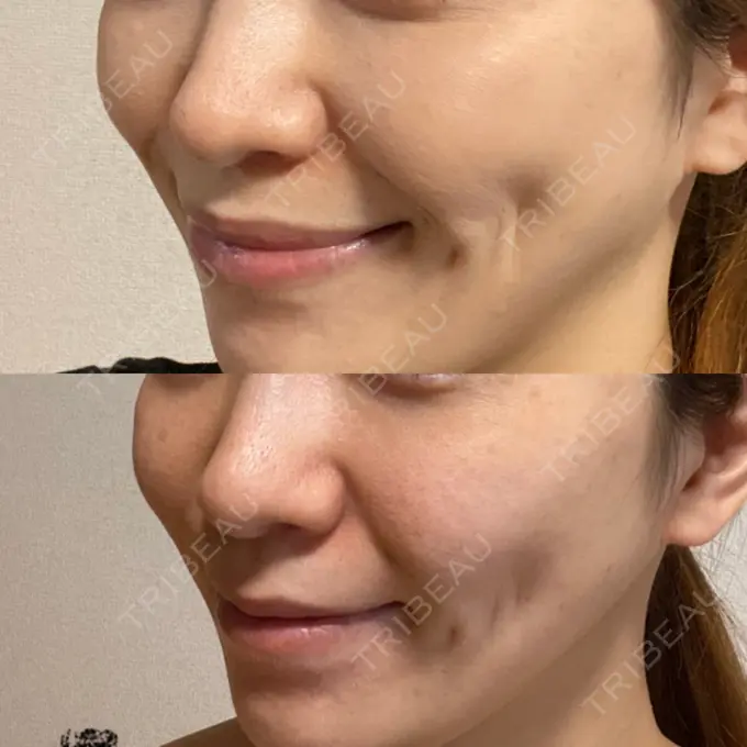 メーラーファット除去 ガーデンクリニック 名古屋院 DAY 29 メイン用