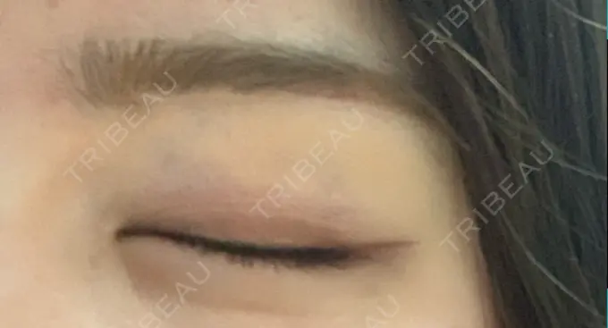 眉下切開 / 眼瞼下垂（非切開） 大塚美容形成外科 銀座本院 DAY 19 メイン用