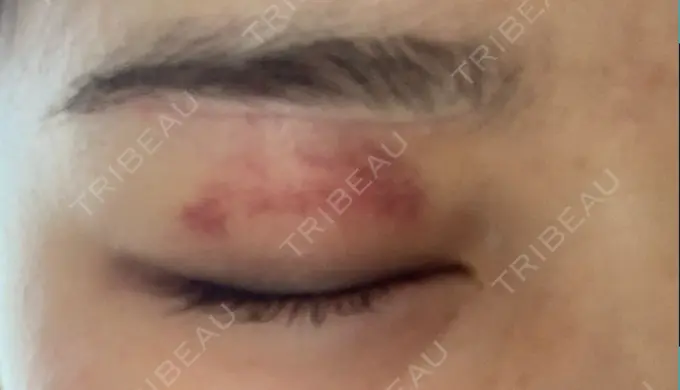 眉下切開 / 眼瞼下垂（非切開） 大塚美容形成外科 銀座本院 DAY 20 メイン用