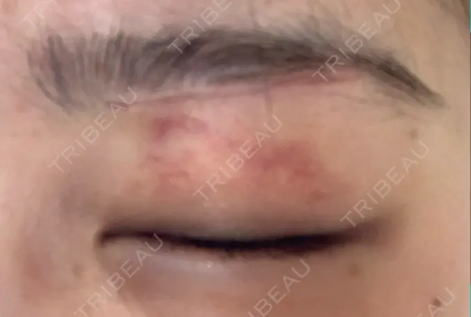 眉下切開 / 眼瞼下垂（非切開） 大塚美容形成外科 銀座本院 DAY 20 メイン用