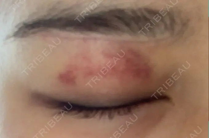 眉下切開 / 眼瞼下垂（非切開） 大塚美容形成外科 銀座本院 DAY 26 メイン用