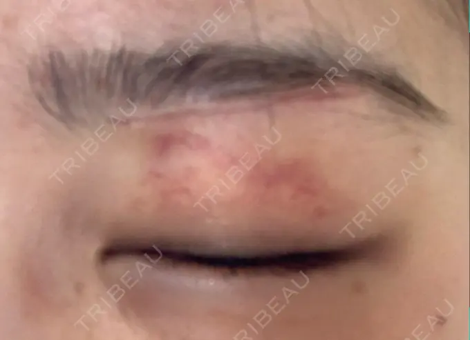 眉下切開 / 眼瞼下垂（非切開） 大塚美容形成外科 銀座本院 DAY 26 メイン用