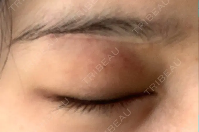 眉下切開 / 眼瞼下垂（非切開） 大塚美容形成外科 銀座本院 DAY 32 メイン用