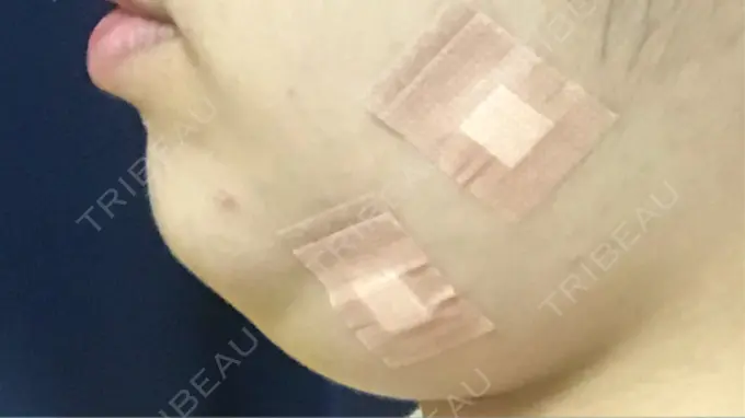 脂肪溶解注射（顔） 東京ロイヤルクリニック DAY 0 メイン用