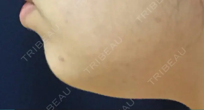 脂肪溶解注射（顔） 東京ロイヤルクリニック DAY 1 メイン用